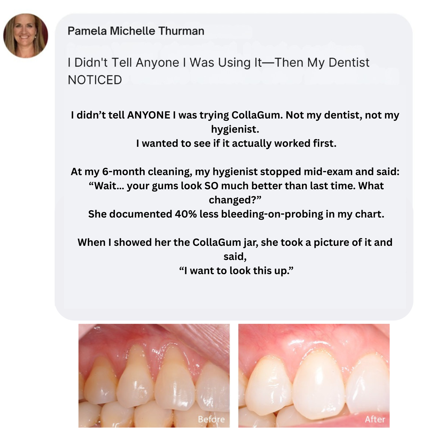 Nudent Gingival Maritime Collagen — Receding Gums & Tissue Regeneration