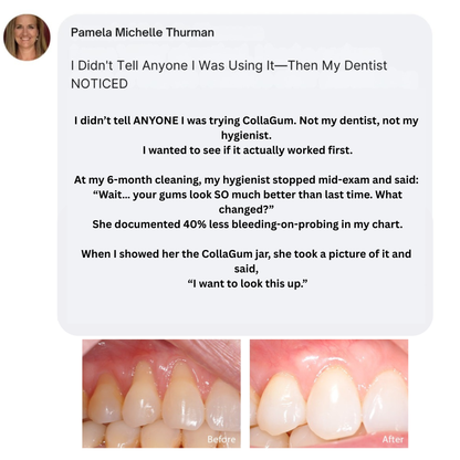 Nudent Gingival Maritime Collagen — Receding Gums & Tissue Regeneration