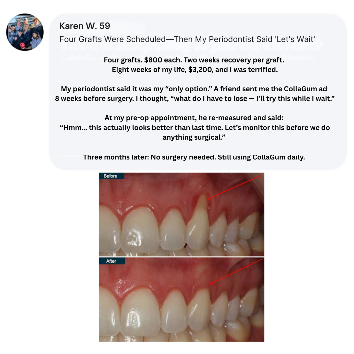 Nudent Gingival Maritime Collagen — Receding Gums & Tissue Regeneration