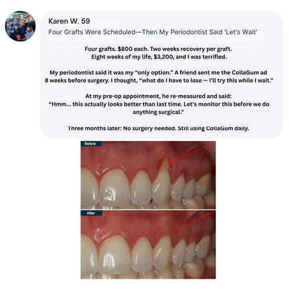 Nudent Gingival Maritime Collagen — Receding Gums & Tissue Regeneration