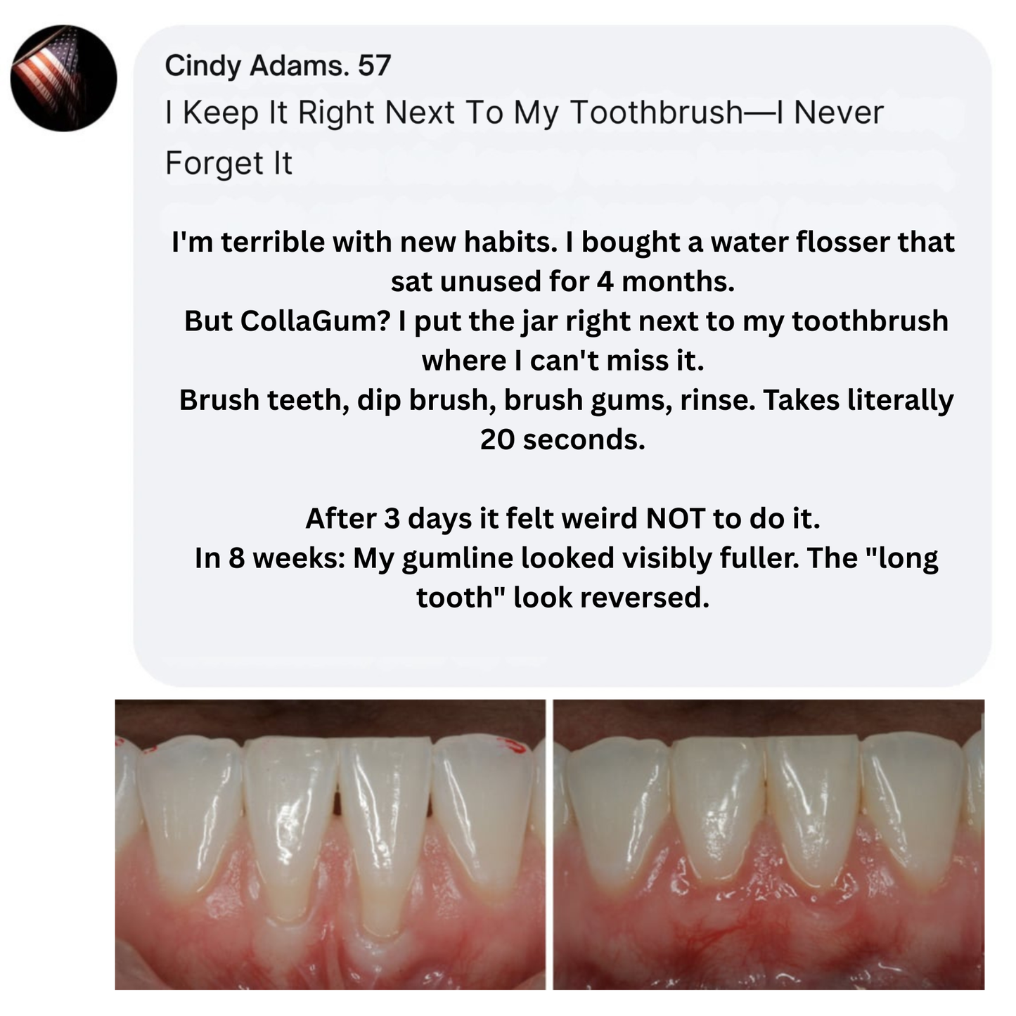 Nudent Gingival Maritime Collagen — Receding Gums & Tissue Regeneration