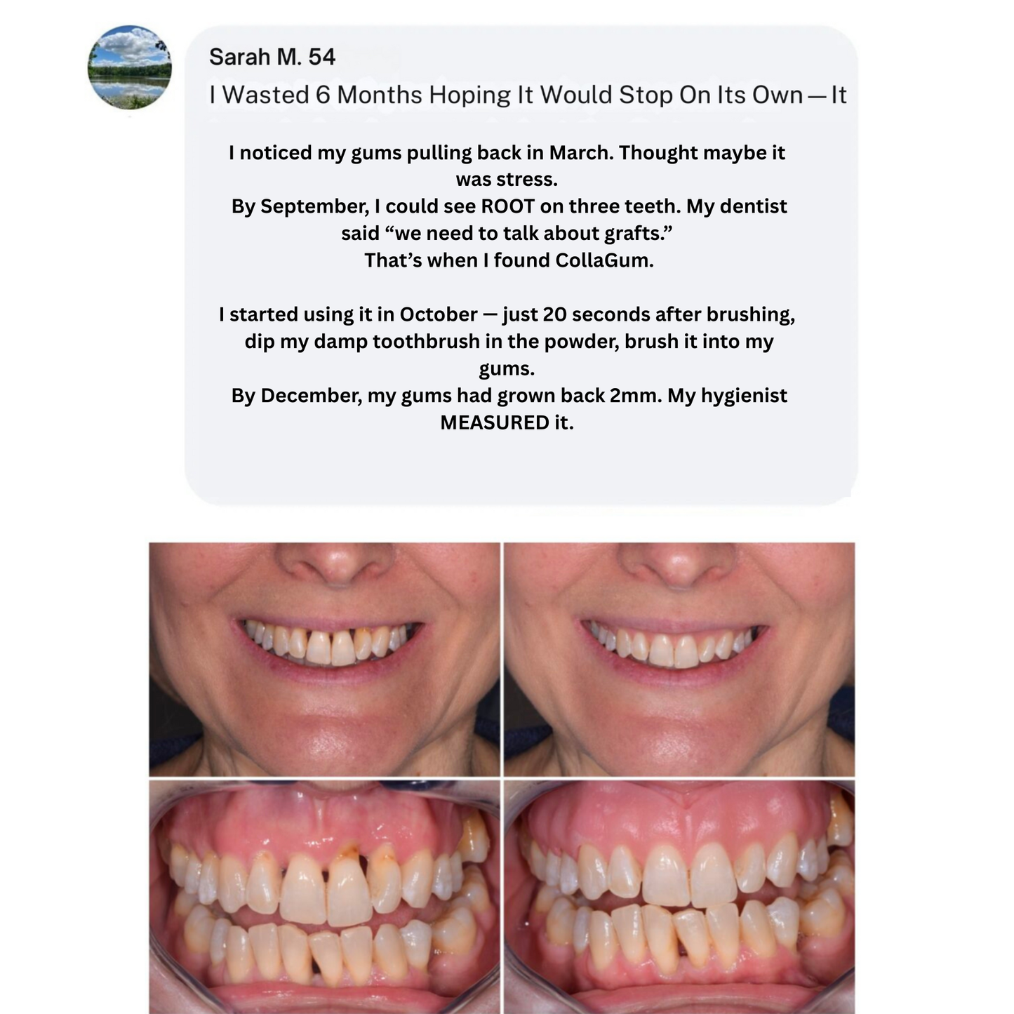 Nudent Gingival Maritime Collagen — Receding Gums & Tissue Regeneration